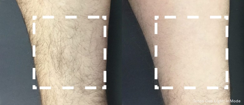 L’épilation au laser - image 6 of 9