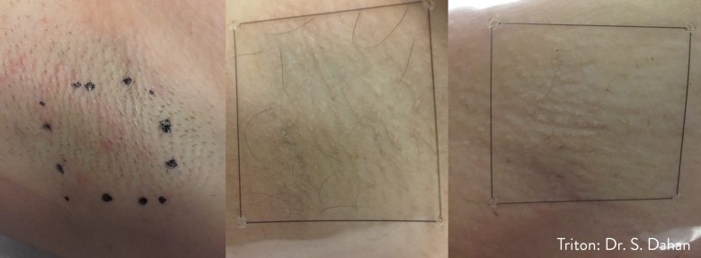 L’épilation au laser - image 9 of 9